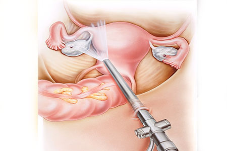 Laparoscopy